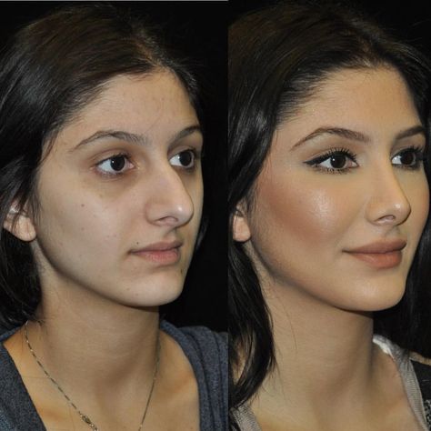 ・・・ One of our beautiful patients before and after #rhinoplasty and #fatgrafting #surgery, by @drgarymotykie . Looking amazing as ever for… Nose Plastic Surgery, Nose Surgery Rhinoplasty, Rhinoplasty Nose Jobs, Nose Reshaping, Hair Implants, Rhinoplasty Before And After, Rhinoplasty Surgery, Fat Grafting, Perfect Nose