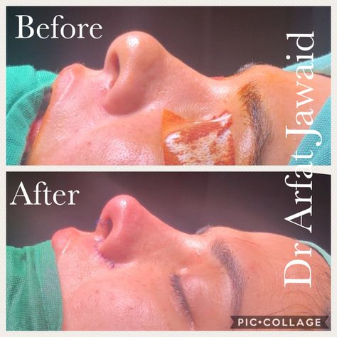 Challenge in this case was a bulbous tip which was too high for the low bridge. You can see that a balanced relationship between the tip and bridge has been restored along with correction of minor deviation. And the best thing is that it still looks like her own nose that is in harmony with the rest of the face.  #Rhinoplasty #Pakistan #PlasticSurgeryDestination #NoseJob #NoseByArfat #NoseReshaping #BulbousTipRhinoplasty #NostrilReduction Rhinoplasty Bulbous Nose, Rhinoplasty Bulbous Tip, Nose Job Bulbous Tip, Rhinoplasty Before And After Bulbous, Nose Jobs Before And After, Bulbous Tip Rhinoplasty, Bulbous Nose Rhinoplasty Before After, Female Hairline, Natural Rhinoplasty