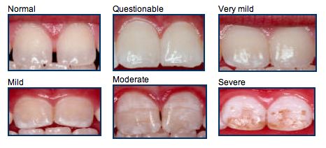 Stages of fluorosis Dental Fluorosis, Much Ado About Nothing, Dental Photography, Discolored Teeth, Mouth Rinse, Dental Veneers, Bold Letters, Food Product, Dental Problems