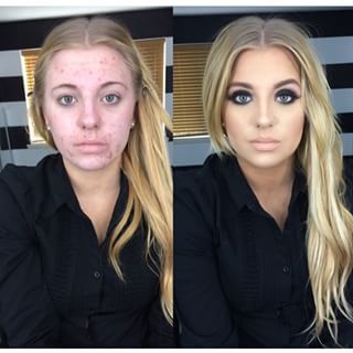 Last January, a friend of hers who runs a makeup Instagram account called @MakeupByDreigh posted this photo of VanPevenage. “I was having this allergic reaction to benzoyl,” VanPevenage told BuzzFeed News. “I knew I needed help to cover my acne.” | After  Discovering She Had Been Turned Into A Cruel Meme, This Woman Decided To Speak Out Before And After Acne, Bad Acne, Makeup Before And After, Power Of Makeup, The Beauty Department, Acne Breakout, Makeup Transformation, Diet Keto, Without Makeup