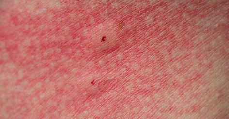 Treating Spider Bites, Spider Prevention, Spider Bites Pictures, Recluse Spider Bite, Spider Identification, Home Remedies For Spiders, Spider Control, Spider Bite, Recluse Spider