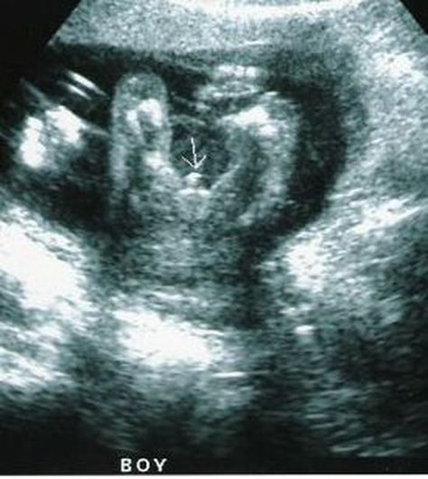 Ultrasound Boy Or Girl, Ultrasound Pictures Gender, 19 Week Ultrasound, Boy Ultrasound Pictures, Boy Ultrasound, 16 Weeks Pregnant Ultrasound, Twins Ultrasound, Ultrasound Gender, Baby Ultrasound Pictures