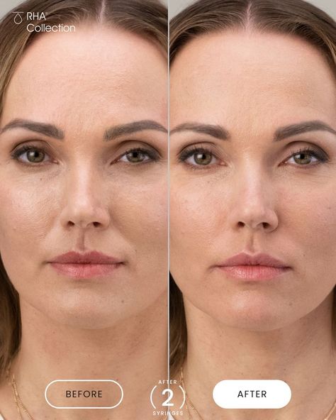 Designed to be more like the natural hyaluronic acid in your skin, the RHA® Collection is expertly made to adapt to dynamic facial expressions for a natural look. Specifically, RHA® 4 is made to add natural volume to dynamic wrinkles and folds. Do you notice the difference in Olena’s before and after photos? She was treated with a total of 2 syringes of RHA® 4 to bring natural volume to her smile and laugh lines. Swipe for Important Safety Information Dynamic Facial Expressions, Hyaluronic Acid Fillers, Facial Fillers, Laugh Lines, Nasolabial Folds, Facial Wrinkles, Smile Lines, Natural Structures, Face Exercises