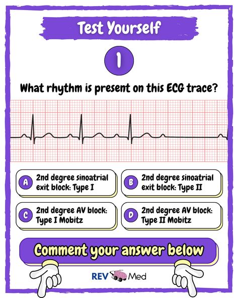 Take a sec and read the notes below 🫀More Cardio loading ⤵️ ☺️ While there is a lot to cover, you will not be worried because following this page will have you covered daily! Just be sure to follow 👉🏼 @rev.med ✅ Heart Blocks 🫀 First Degree *Rhythm: Narrow & Regular *PR Interval: Prolonged PR (PR > 200 ms - 5 small squares *P Wave: Normal *QRS: < 0.11 sec *No Tmt 🫀 2nd Degree ‘Wenckebach’ *Rhythm: Increasingly prolonged, Narrow & irregular *PR Interval: Irregular, PR longest before dropp... Nursing Knowledge, Pr Interval, P Wave, Medical Animation, Heart Blocks, Cardio, Nursing, Medical, Reading