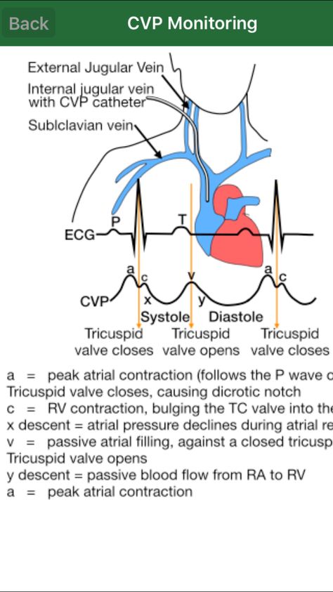 CVP monitoring Central Venous Pressure, Cardiology Nursing, Nursing Information, Cardiac Nursing, Critical Care Nursing, Respiratory Therapy, Nursing School Studying, Emergency Nursing, Nursing School Notes