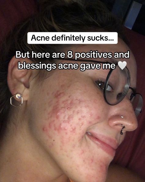 Thank you, acne 🤍. #adultacne #pcosacne #clearskin #glassskin #acnepositivity #acneneutrality Acne Normalization, Skincare That Helps With Acne, How To Feel Pretty With Acne, Spiralactone For Acne, How To Get Rid Of Acne Scabs Overnight Dark Spots, At Home Facial For Acne, Acne Skin Aesthetic, Pimple Location Meaning, How To Reduce Acne