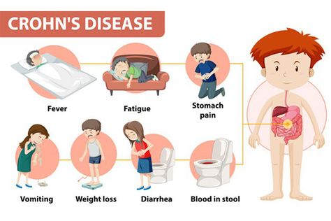 Inflammatory Bowel Disease – A medical condition when the large bowel (large intestine) or small bowels (small intestines) gets inflamed due to various reasons. Crohn’s disease is one such Inflammatory Bowel Disease that causes inflammation of the digestive tract. The areas affected by this disease can vary from person to person and it can often spread into the deeper layers of the intestines. First Symptoms Of Pregnancy, Brain Gym Exercises, Medical Infographic, Gastric Problem, Inflammatory Bowel, Reflux Disease, Disease Symptoms, Asthma Symptoms, Stomach Problems