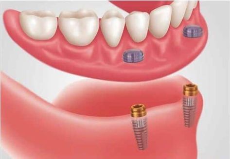 Affordable Dental Implants, Implant Dentist, Denture Implants, Best Dental Implants, Dental Implant Surgery, Dental Implants Cost, Dental Tourism, Tooth Replacement, Implant Dentistry