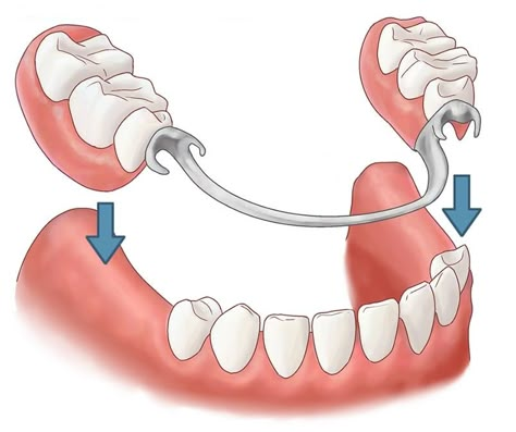 Prosthetic Device, Denture Adhesive, Tooth Repair, Dental Health Care, Dental Implants Cost, Partial Dentures, False Teeth, Laser Teeth Whitening, Tooth Replacement