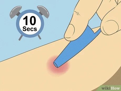 11 Ways to Get Rid of a Mosquito Bite - wikiHow Misquote Itch Relief, Itchy Bug Bite Remedy, Stop Mosquito Bite Itch, Bug Bite Itch, Mosquito Bite Relief, Mosquito Bite Itch, Itchy Bug Bites, Remedies For Mosquito Bites, Bug Bites Remedies