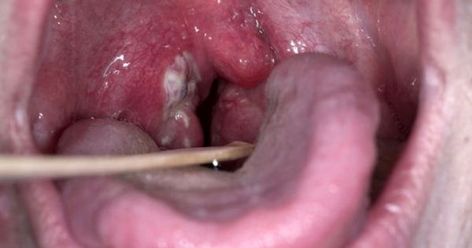 Symptoms of Streptococcal Bacterial Infections Strep Throat Symptoms, Saline Nasal Spray, Lymph Glands, Throat Remedies, Throat Pain, Throat Infection, Strep Throat, Healthy Substitutions, Bacterial Infection