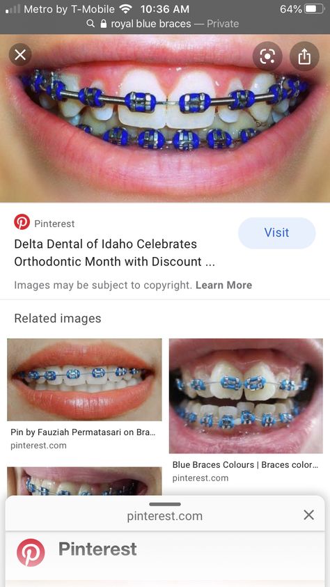 Royal Blue Braces, Braces Journey, Blue Braces, Sophomore Year, Braces, Blue, Quick Saves