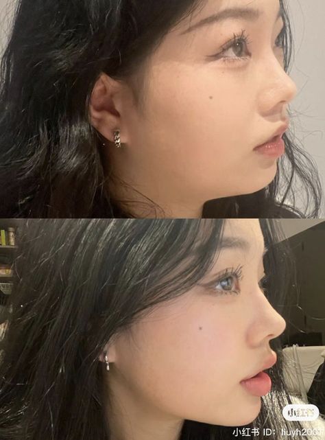 Jaw Reduction Surgery, Perfect Side Profile, Nose Fillers, Chin Filler, Chin Implant, Botox Before And After, Lips Inspiration, Rhinoplasty Nose Jobs, Face Fillers