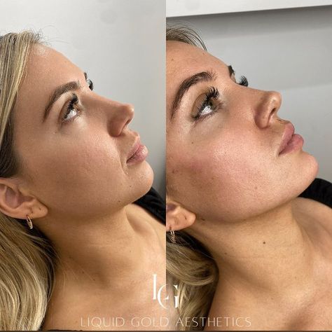 Nose Lift, Gold Aesthetics, Chin Filler, Chin Implant, Lips Inspiration, Face Fillers, Cheek Contour, Cheek Fillers, Beauty Procedures