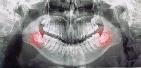 Different types of wisdom teeth problems... | Premium Photo #Freepik #photo #medical #dental #teeth #tooth Impacted Wisdom Teeth, Teeth Problems, After Wisdom Teeth Removal, Dental Extraction, Wisdom Tooth Extraction, Dental Check Up, Wisdom Teeth Removal, Jaw Pain, Tooth Removal