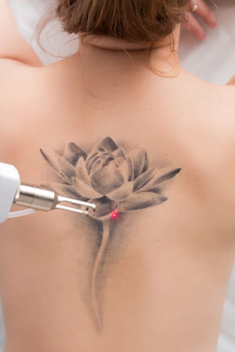 Embark on your tattoo removal journey with confidence using our comprehensive day-by-day healing guide at CleanSlate Laser Clinic. From immediate aftercare to long-term care tips, discover how to manage redness, swelling, and scabbing effectively. Learn the best practices to ensure a smooth recovery and optimal results for your skin.

#TattooRemovalGuide
#SkinHealing
#LaserClinic Picosure Tattoo Removal, 5 Tattoo, Laser Clinics, Aesthetic Clinic, Laser Tattoo, Laser Tattoo Removal, Spine Tattoo, Laser Skin, Spine Tattoos