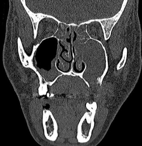 Oroantral fistula - openings less than 2 mm wide usually heal without intervention - larger fistulas may require surgery - disruption or defect involving the bony floor of the maxillary sinus with soft-tissue opacification at related sinus Maxillary Sinus, Surgery, Moose Art, Animals, Quick Saves, Art