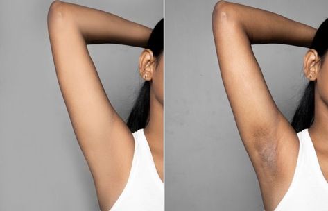 How To Lighten Underarms, Lightening Underarms, Natural Mask, Underarm Hair Removal, Prevent Ingrown Hairs, Dark Underarms, Exfoliating Scrub, Laser Therapy, Some Body