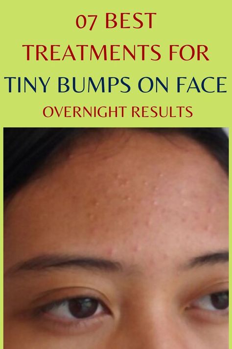 07 Best Treatments For Tiny Bumps On Face - Overnight Results Small Pimples On Face, Tiny Bumps On Face, Red Bumps On Face, Skin Bumps On Face, White Bumps On Face, Small Bumps On Forehead, Bumps On Face, How To Prevent Blackheads, Small Bumps On Face