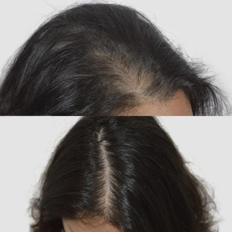 Female Gallery — Advanced Hair Restoration Hair Before And After, Female Hair Transplant, Hair Transplant Women, Arrow Image, Scalp Micropigmentation, Scalp Brushing, Women Health Care, Female Hair, Photo Restoration