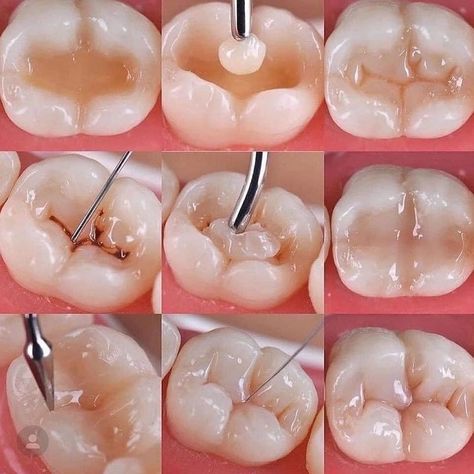 Dental Pictures, Dental Assistant Study, Dental Hygiene Student, Dental Aesthetics, Dental Restoration, Dental Videos, Kedokteran Gigi, Dental Hygiene School, Dentistry Student