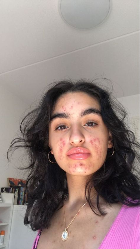 Strawberry Freckles, Acne Is Beautiful, Acne Is Normal, Girl With Acne, Acne Positivity, Skin Positivity, Bad Acne, Real Skin, How To Get Rid Of Pimples