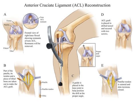 ACL reconstructive surgery is the only way to effectively treat a torn ACL. During surgery, a graft is taken from a chosen tendon and threaded through a hole drilled in the tibia into the femur. Read more about it on MagpieStory ! Acl Surgery Recovery, Acl Reconstruction Surgery, Knee Surgery Recovery, Acl Recovery, Acl Surgery, Orthopedic Doctor, Anterior Cruciate Ligament, Ligament Tear, Acl Tear