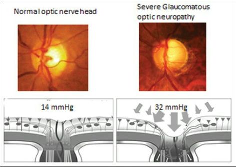 Ophthalmic Technician, Optic Nerve, Nerve Fiber, Nerve Damage, Eye Health, Fiber Optic, Nerve, An Eye, Health Care