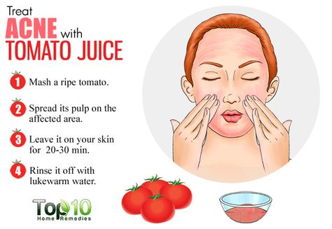 Benefits Of Tomatoes, Model Beauty Tips, Acne Home Remedies, Top 10 Home Remedies, Skin Care Routine For 20s, Remedies For Acne, Pimples Overnight, Tips For Acne, Natural Acne Remedies