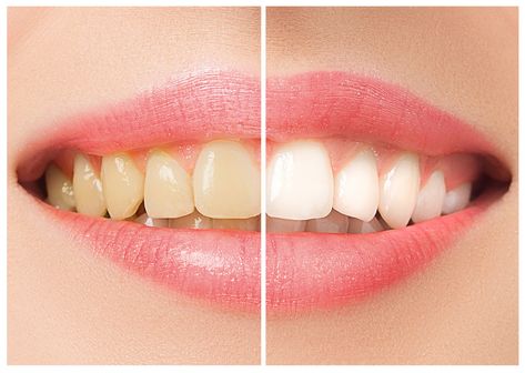 Dental Bleaching, Cosmetic Dentistry Procedures, Discolored Teeth, Laser Teeth Whitening, Teeth Bleaching, Nice Teeth, Dental Bridge, Dental Crowns, Dental Surgery