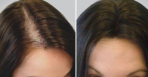 Le complément qui stoppe la chute des cheveux, les épaissit et les fait repousser - OohMyMag Hair Transplant Women, Hair Transplant Cost, Female Pattern Baldness, Dramatic Hair, Pattern Baldness, Lost Hair, Pregnancy Symptoms, Hair Starting, Hair Regrowth