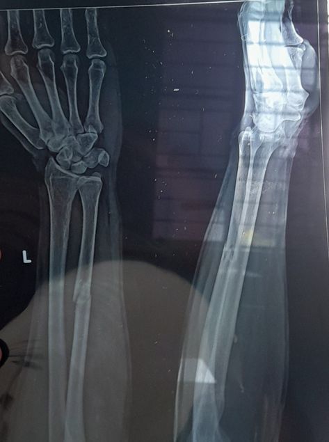 X-ray:Fracture of distal shaft of (lt) ulna. Knee Injury Snapchat, Hand Fracture Pics, Hand Fracture, Cash Indian, Money Images Cash Indian, Fake Injury, Broken Arm, Medical School Motivation, Dj Setup