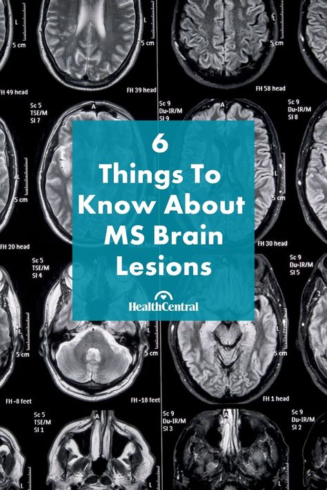 Primary Lateral Sclerosis, Lesions On Brain, Ms Symptoms In Women, Ms Diet Multiple Sclerosis For Women, Muscular Sclerosis, Multiple Scelorsis, Ms Treatments, Ms Facts, Multiple Sclerosis Diet