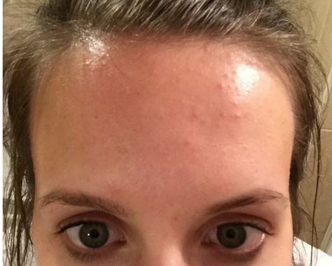 How I Cleared the Tiny Bumps on my Forehead Forehead Breakout Causes, Tiny Pimples All Over Face, Bumpy Forehead Remedy, Skin Care For Bumps On Face, Bumpy Skin On Face, Bumpy Forehead, Tiny Bumps On Forehead, Tiny Bumps On Face, Clear Forehead