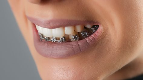 Bottom Teeth Braces, Permanent Retainer, After Braces, Braces Cost, Bottom Teeth, Invisalign Aligners, Straight Smile, Invisible Braces, Clear Braces