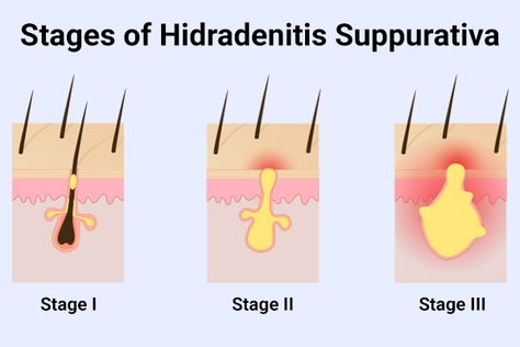 How to Treat Hidradenitis Suppurativa - eMediHealth Acne Inversa, Hair Growth Spray, Under The Skin, Sweat Gland, Natural Cold Remedies, Skin Condition, Cold Remedies, Skin Diseases, Natural Treatments