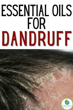 Essential Oils For Dandruff, Home Remedies For Cold, Diy Shampoo Recipe, Shampoo Diy, Natural Dandruff Remedy, Oils For Dandruff, Dandruff Remedy, Kitchen Herbs, Natural Healing Remedies