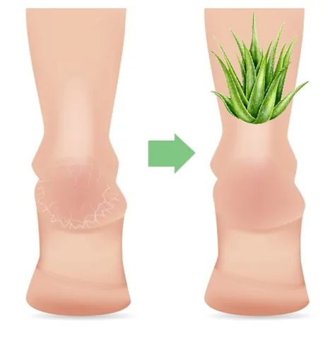 Fungal Nail Aloe Benefits, Aloe Vera Gel Benefits, Nail Remedies, Pure Aloe Vera Gel, Cut Blouse, Fungal Nail, Pure Aloe Vera, Aloe Gel, Aloe Vera Plant