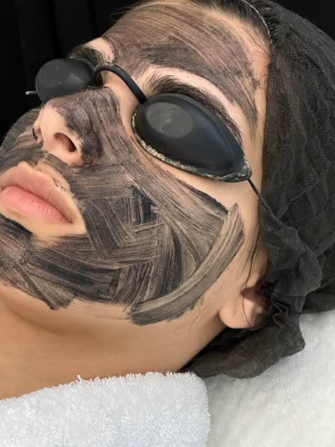 Carbon Peeling Laser, Hollywood Facial, Carbon Laser Facial, Hollywood Peel, Carbon Facial, Salon Marketing Social Media, Carbon Peel, Facial Pics, Carbon Laser