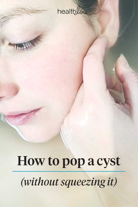 How to Pop a Cyst When You’re at Home Ear Pimple, Painful Pimple, Cystic Pimple, Blind Pimple, Pimples Under The Skin, Acne Vulgaris, Natural Acne Remedies, Acne Skincare Routine, Types Of Acne