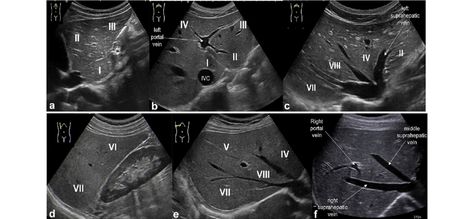 Liver Segments, Abdomen Ultrasound, Ob Ultrasound, Diagnostic Medical Sonography Student, Abdominal Ultrasound, Ultrasound School, Medical Radiography, Sonography Student, Abdominal Aorta