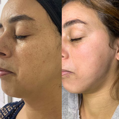 Result Treatment For Pigmentation Sunspots After A Month Skin Before And After, Before After Skincare, Laser Peel, Skin Facts, Before After, Open Pores, Basic Skin Care, Basic Skin Care Routine, Beauty Center