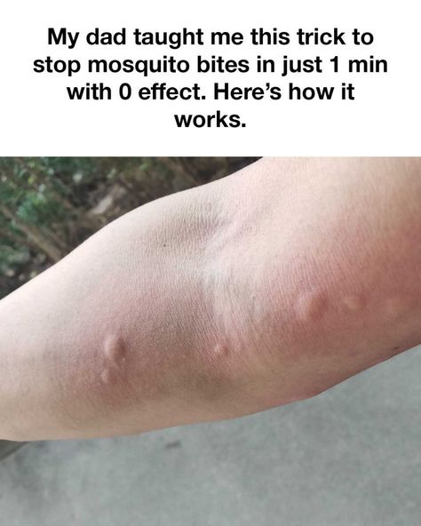 Can't wait to try this next time! These guys always get me! Itchy Mosquito Bite Remedy, Mosquito Bite Remedy, Remedies For Mosquito Bites, Bug Bites Remedies, How To Store Strawberries, Bed Bug Spray, Sick Remedies, Mosquito Bites, Homemade Cleaning Solutions