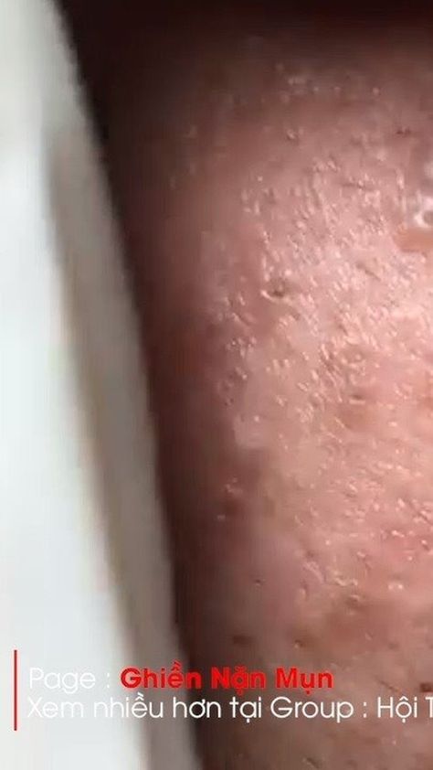 Instagram post by Pimple Popper Videos • Sep 10, 2020 at 8:00am UTC Pimple Removal Video, Overnight Pimple Remedies, Zit Remedy, Lip Pimple, Head Pimples, Black Head Removal, Painful Pimple, Pimple Removal, Small Pimples