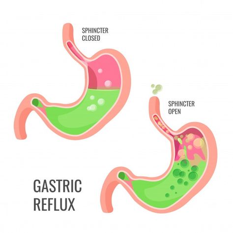 Gastric reflux illustration. closed and ... | Premium Vector #Freepik #vector #health #anatomy #stomach #illness Vegan Probiotics, Low Stomach Acid, Acid Reflux Diet, Human Organ, Newborn Feeding, Promo Poster, Healthy Morning Routine, Stomach Problems, Nursing Tips