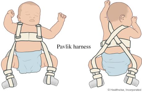 Pavlik harness - abduction splinting Pavlik Harness, Hip Dysplasia, Great Expectations, Nursing Education, Crazy Life, Nclex, Parenting Blog, Medical Information, Important Facts