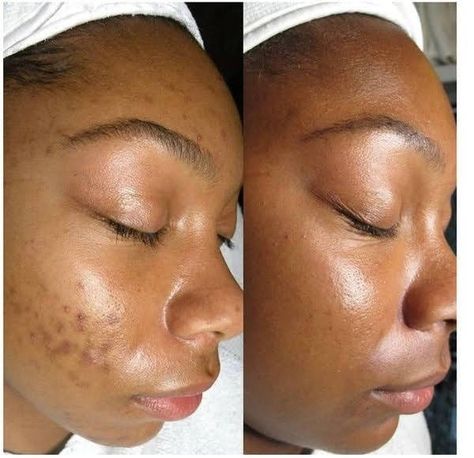 Resultados skincare 
Benefícios skincare 
Aesthetic skin
Better skin 
Spring 🌼
Cuidados com a pele
SKINCEPTION Before And After Skincare, Acne Holes, Hyperpigmentation Mask, Aloe Face Mask, Skin Hyperpigmentation, Prevent Ingrown Hairs, Brazilian Waxing, Skin Discoloration, Chemical Peel