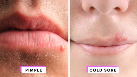 How to Identify a Herpes Cold Sore vs. Pimple — Expert Advice | Allure Pimples Around Lips, Pimples On Lip Line, Cold Sore Scab, Cold Sore Stages, Blister On Lip, What Causes Pimples, Lip Pimple, Painful Pimple, Painful Acne