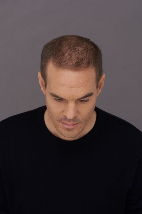 If you’re unhappy with your hairline, you’re not alone. Receding hairlines are extremely common for guys. In fact, about two-thirds of men will experience hair loss at some point in their lives. However, not all “bad hairlines” are caused by hair loss. Some people just naturally have a crooked hairline, while for others, an uneven hairline could be the result of a bad haircut. Whatever the cause, we have some five solutions to help you fix your hairline, making it look fuller and more even. Uneven Hairline, Bad Hairline, Shampoo Design, Bad Haircut, Blow Dry Hair, Vitamins For Hair Growth, Hydrate Hair, Scalp Conditions, Celebrity Hair Stylist