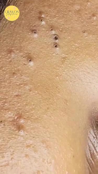 How To Remove Blackheads, Healthy Low Carb Snacks, To Remove Blackheads, Zits Popping, Clean Blackheads, Acne Help, Cold Sores Remedies, Remove Blackheads, Natural Sleep Remedies